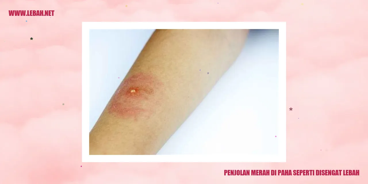 penjolan merah di paha seperti disengat lebah